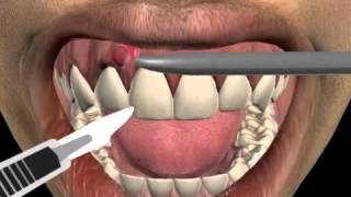 How to treat a tooth abscess [upl. by Ikoek]