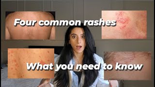 Four common rashes and everything you need to know about them [upl. by Ainafetse463]