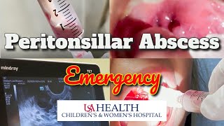 Peritonsillar Abscess Emergency and Needle Aspiration [upl. by Emmeram]