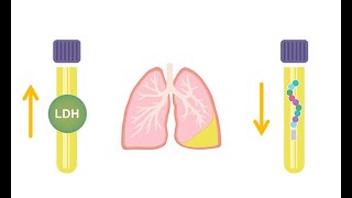 Differentiating transudative and exudative effusions transudate vs exudate [upl. by Maer]