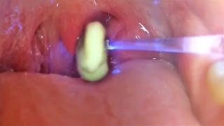 Worlds Greatest Tonsil Stone Removals 2 [upl. by Vanzant]