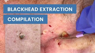 Extraction Satisfaction Blackhead Removal  CONTOUR DERMATOLOGY [upl. by Nnylyar417]