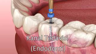 Kanal Tedavisi  Endodonti [upl. by Ricketts]