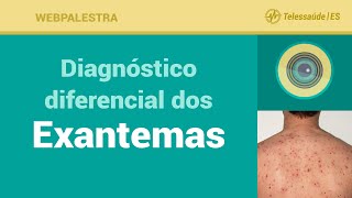 Webpalestra Diagnóstico diferencial dos Exantemas  Telessaúde ES 02062016 [upl. by Ben]