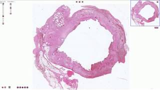 Chronic Cholecystitis  Histopathology [upl. by Wright104]