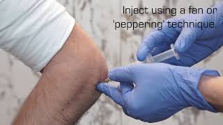 Injection Technique for Lateral Epicondylalgia [upl. by Icam]