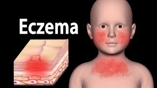 Eczema Animation [upl. by Cortie]