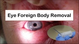 Eye Foreign Body Removal [upl. by Assylem]