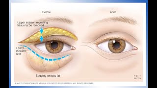 NonSurgical Eyebag Removal at Cambridge Medical [upl. by Traci]