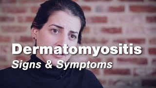 Dermatomyositis – Signs amp Symptoms  Johns Hopkins [upl. by Airekahs353]