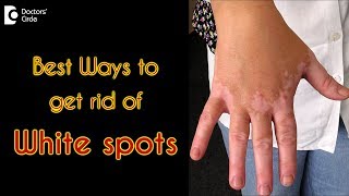 How to treat white spots on the skin  Dr Rasya Dixit [upl. by Annavoig]