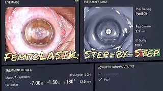 BladeFree Femto Laser Robotic Cataract Eye Surgery in Delhi  Sharp Sight [upl. by Bonne666]