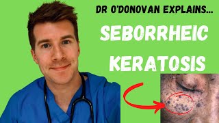 Explaining Seborrheic Keratosis  With Dr ODonovan [upl. by Fulcher]