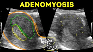 Adenomyosis  Ultrasound  Case 42 [upl. by Eidlog]