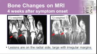 Rheumatoid Arthritis New Guidelines for Diagnosis and Management [upl. by Adnerak568]