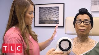 Removing Moles with Liquid Nitrogen  Dr Pimple Popper [upl. by Vite]