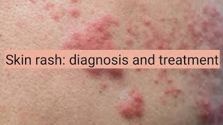 Skin Rash diagnosis and treatment [upl. by Avehsile368]