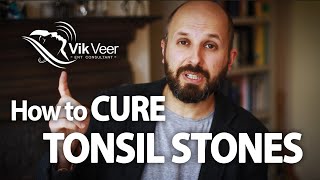 How to Cure Tonsil Stones [upl. by Caterina691]