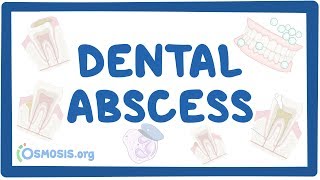 Dental abscess  causes symptoms diagnosis treatment pathology [upl. by Annola747]