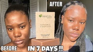 ESTHETICIAN Tries Turmeric Soap For A Week  THIS HAPPENED [upl. by Gnouhp]