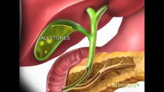 Acute Cholecystitis Gallbladder Attack Meditoons™ [upl. by Nauh845]