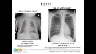 Peripheral Intravenous Line Placement by B Johnson L DelSignore  OPENPediatrics [upl. by Nylaret]