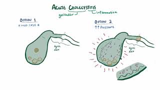 Chronic Cholecystitis with Acute Exacerbation  Histopathology [upl. by Christian233]