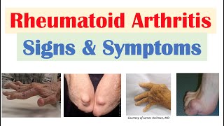 Rheumatoid Arthritis RA Signs amp Symptoms amp Associated Complications [upl. by Beryle]