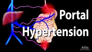 Portal Hypertension Animation [upl. by Attenauqa]