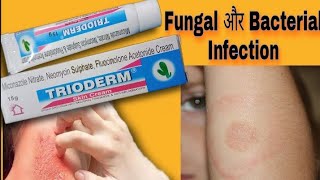 TRIODERM Skin cream in Hindi  Fungal infection best Cream [upl. by Edia]