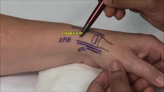 1st CMC Joint Injection [upl. by Cyrie]