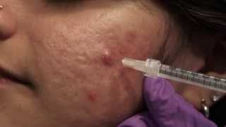 Watch amp Learn Intralesional injections [upl. by Euqinay]