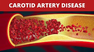 Internal Carotid Artery  Anatomy Branches amp Relations [upl. by Yemac186]