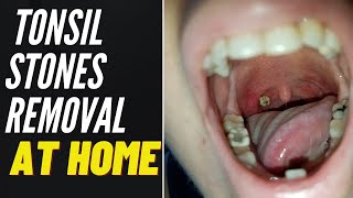 TONSIL STONE REMOVAL At Home 2021 [upl. by Shae]