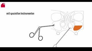 Nasal polyps  PHACON Sinus Patient Meyer [upl. by Eugor]