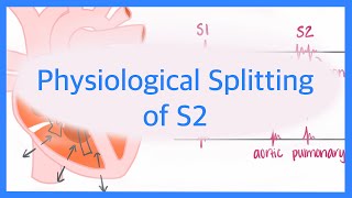 Physiological Splitting of S2 [upl. by Giwdul]