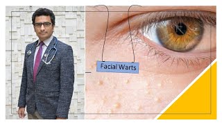 Facial Warts In Children [upl. by Joby216]