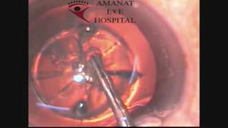 Laser Eye Surgery  Laser Treatment For Eye  Femto Lasik Eye Surgery In Pakistan  Hassan Mansoor [upl. by Nad]