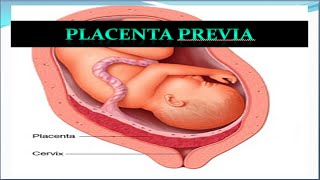 Placenta Previa Update [upl. by Lauer]