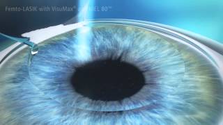 What Is FEMTO Lasik [upl. by Valerie633]