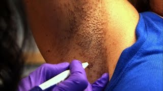 Womans Armpit Mystery Skin Condition Solved [upl. by Jarek]