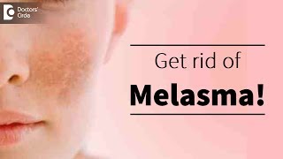 Melasma or pigmentation of skin Treatment available  Dr Deepak P Devakar [upl. by Eberhart]