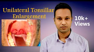 Unilateral Tonsillar Enlargement Aetiologies and Evaluation [upl. by Ragouzis784]