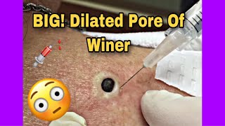 Dilated Pore Of Winer ExtractionRemoval 2019 Video [upl. by Kehr]