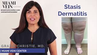 About Stasis Dermatitis Leg Discoloration [upl. by Enilraep324]