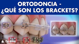 Ortodoncia – Brackets y otras partes del aparato dental © [upl. by Amapuna635]