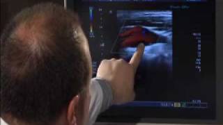 CAROTID ULTRASOUND THE CAROTID BIFURCATION [upl. by Yalahs745]