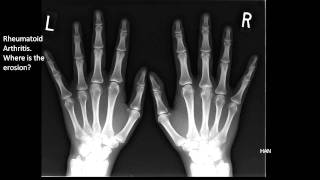 Image of the Month Rheumatoid Arthritis XRay [upl. by Nabetse]