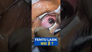 femtoLasik procedure [upl. by Kitti133]