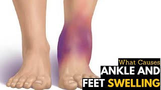 What Causes Ankles amp Feet Swelling  Diagnosis amp Treatment [upl. by Marola]